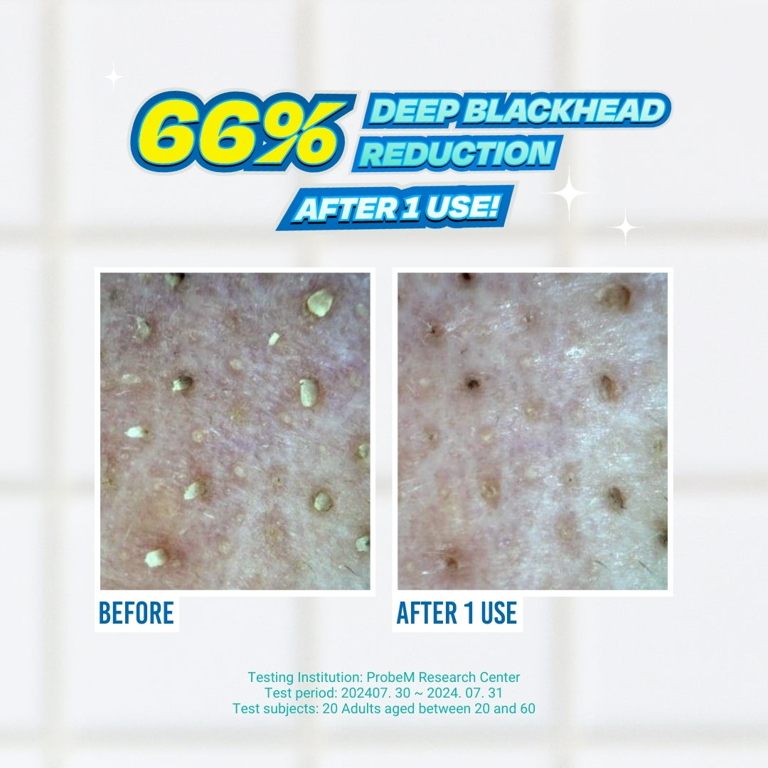 Blackhead Melting Softner (150ml + Cotton Pad 40ea + Cotton Swab 10ea)